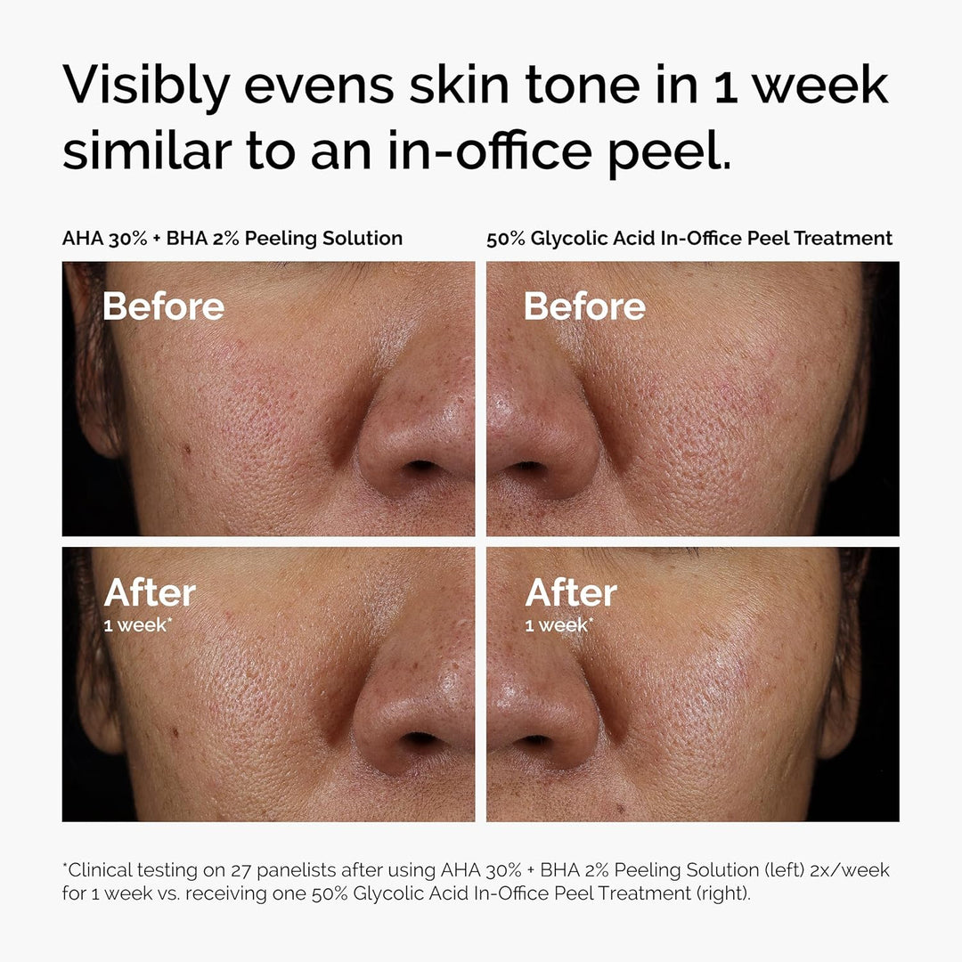 The Ordinary AHA 30% + BHA 2% Peeling Solution, Advanced Exfoliating Peel for Brighter Skin